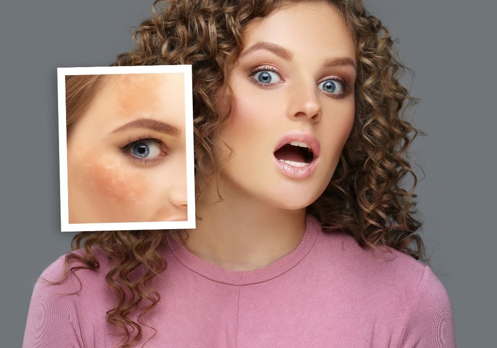 Como usar o ácido tranexâmico na rotina de skincare