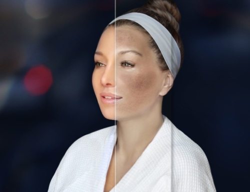 Produto kincare para Cloasma – Máscara da Gravidez